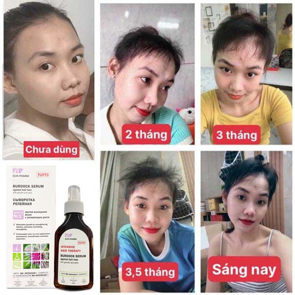 serum-ngan-ngua-rung-toc-va-ho-tro-moc-toc-elfa-pharm-3
